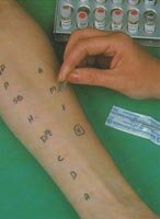 Skin Prick Testing